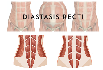 دیاستازیس عضله رکتوس چیست؟ و فیزیوتراپی دیاستازیس عضله رکتوس